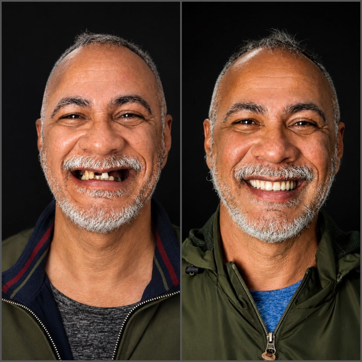 Antes e depois: paciente com dentes faltando e depois com sorriso completo