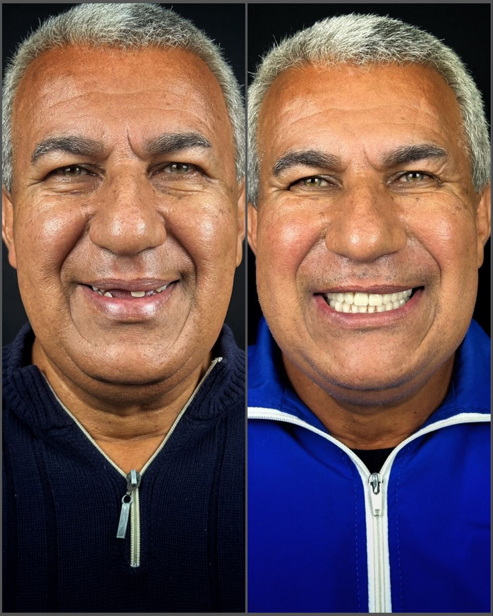 Antes e depois: paciente com poucos dentes e depois com dentes fixos