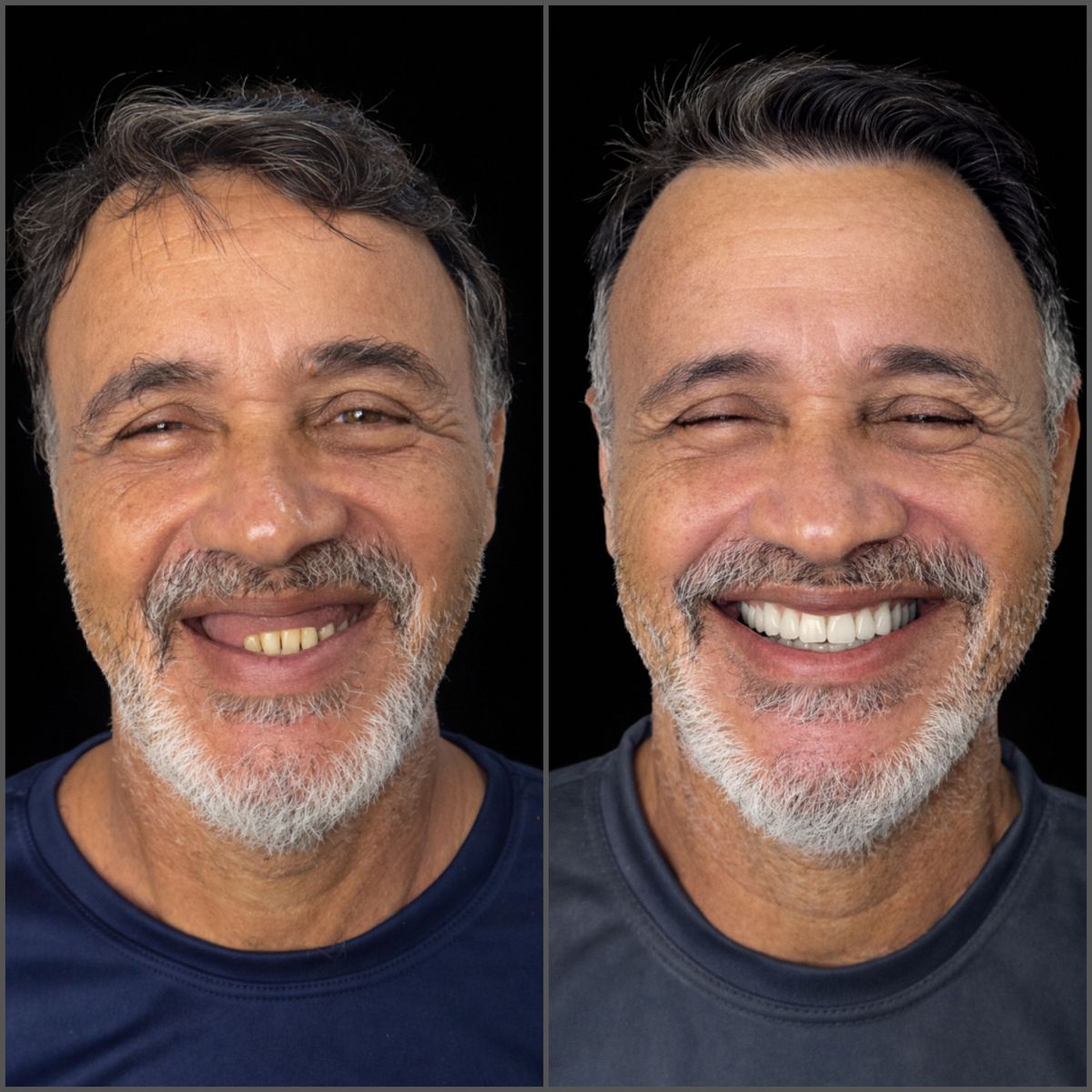 Antes e depois: paciente com dentes desgastados e depois com sorriso completo