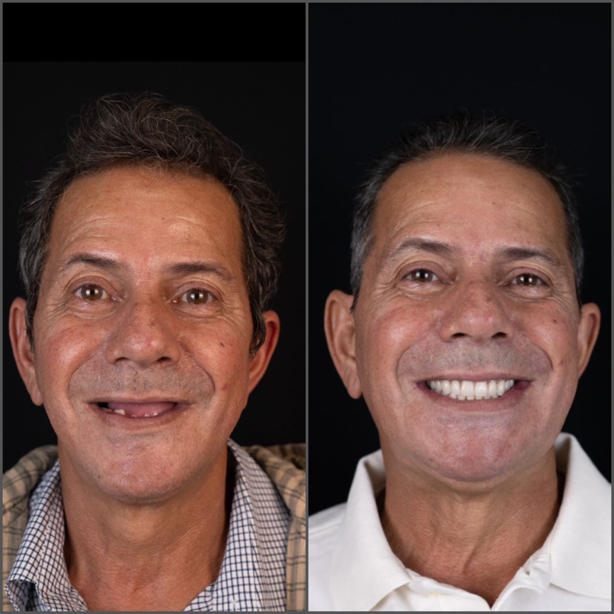 Antes e depois: paciente sem dentes da frente e depois com dentes fixos
