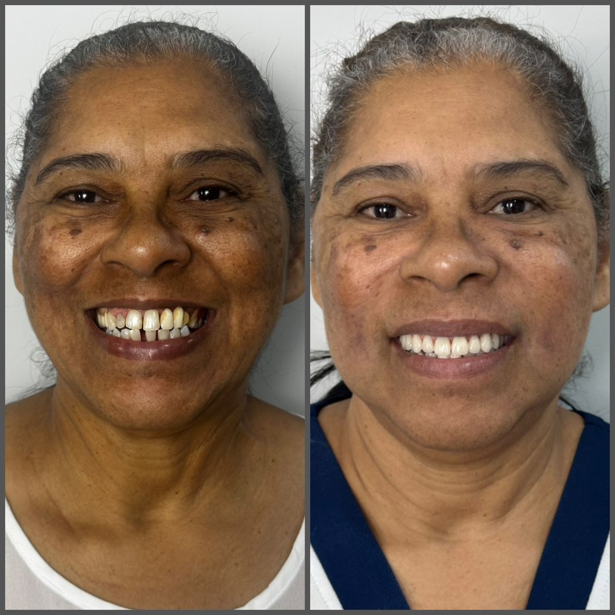 Antes e depois: paciente com espaços entre os dentes e depois com sorriso uniforme