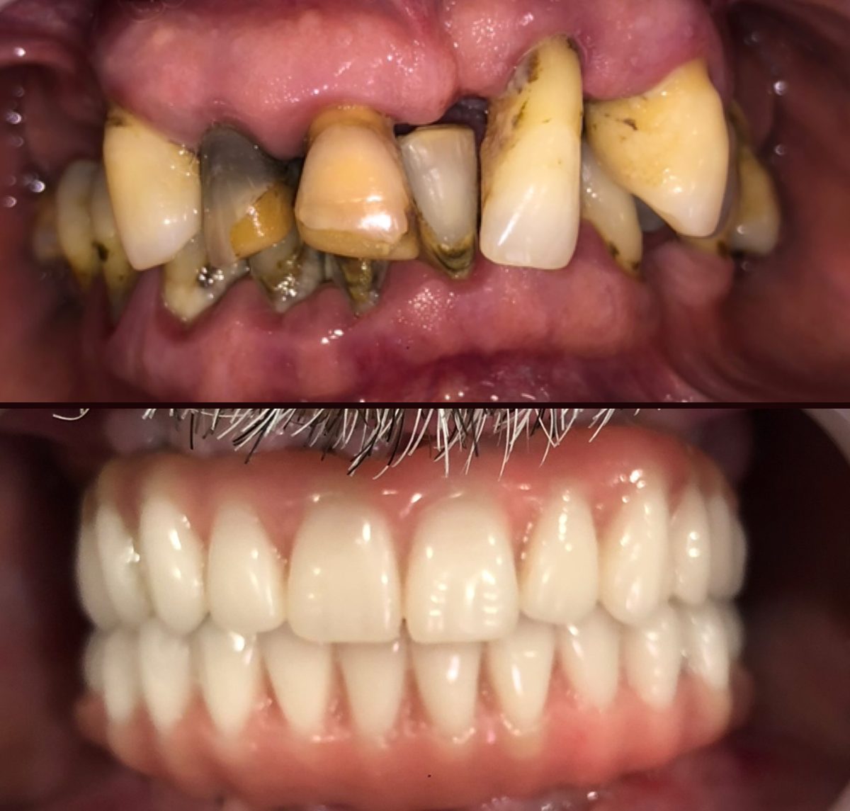 Antes e depois: dentes estragados e depois arcada fixa com protocolo