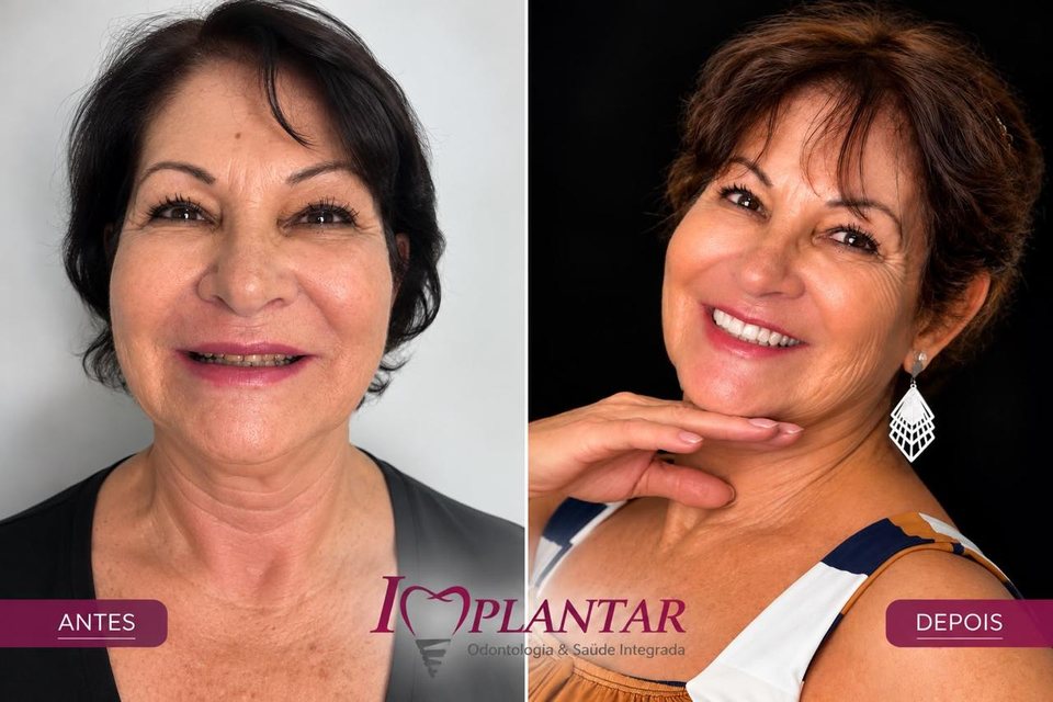 Antes e depois de paciente da Implantar